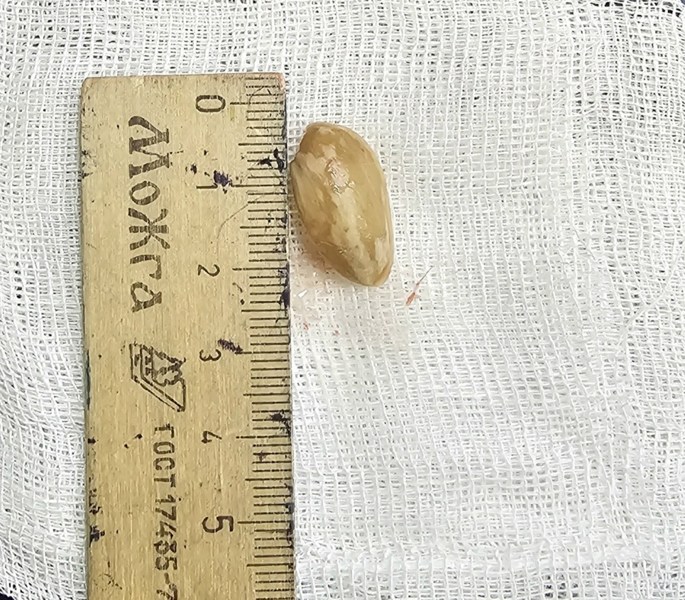 «Кукуруза» оказалась фисташкой: почему диагноз врача может отличаться от слов родителей